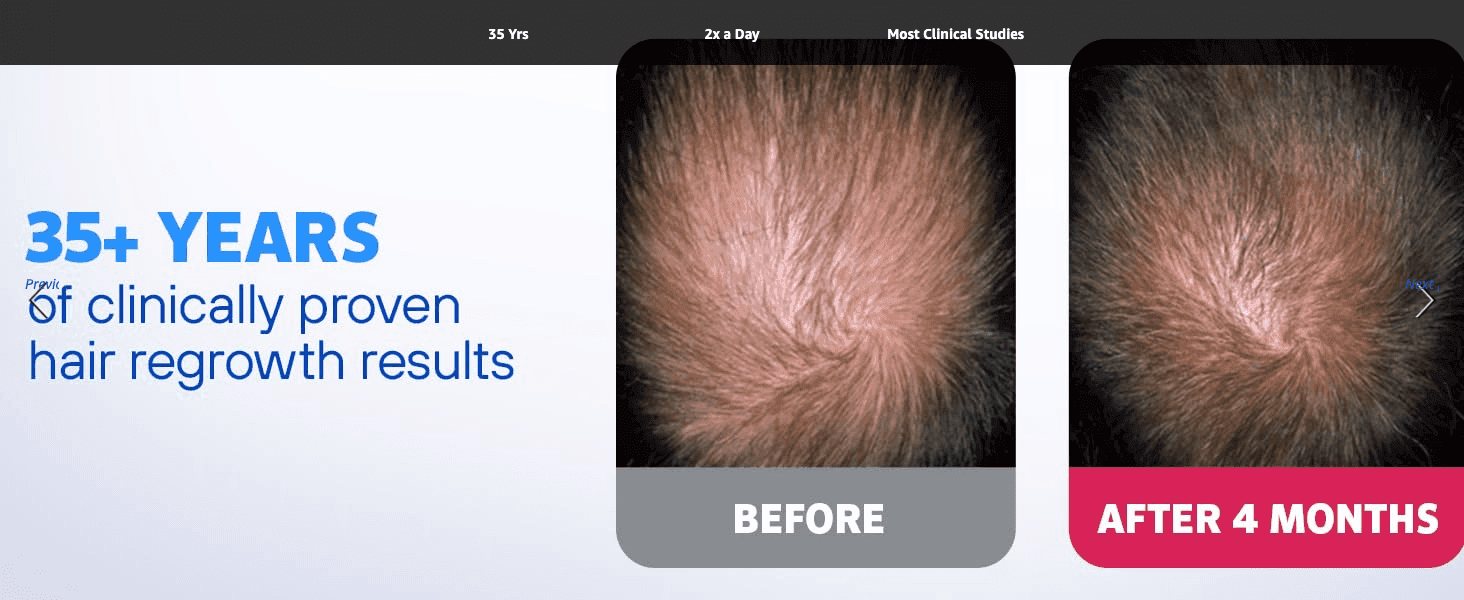 Visually proves the product's effectiveness by showing a customer's scalp before and after 4 months of use.