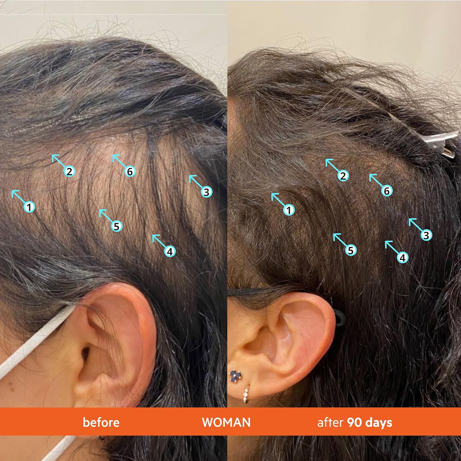 Demonstrates the effectiveness of the product in promoting hair regrowth and treating thinning hair by showing a before and after comparison over a 90-day period.
