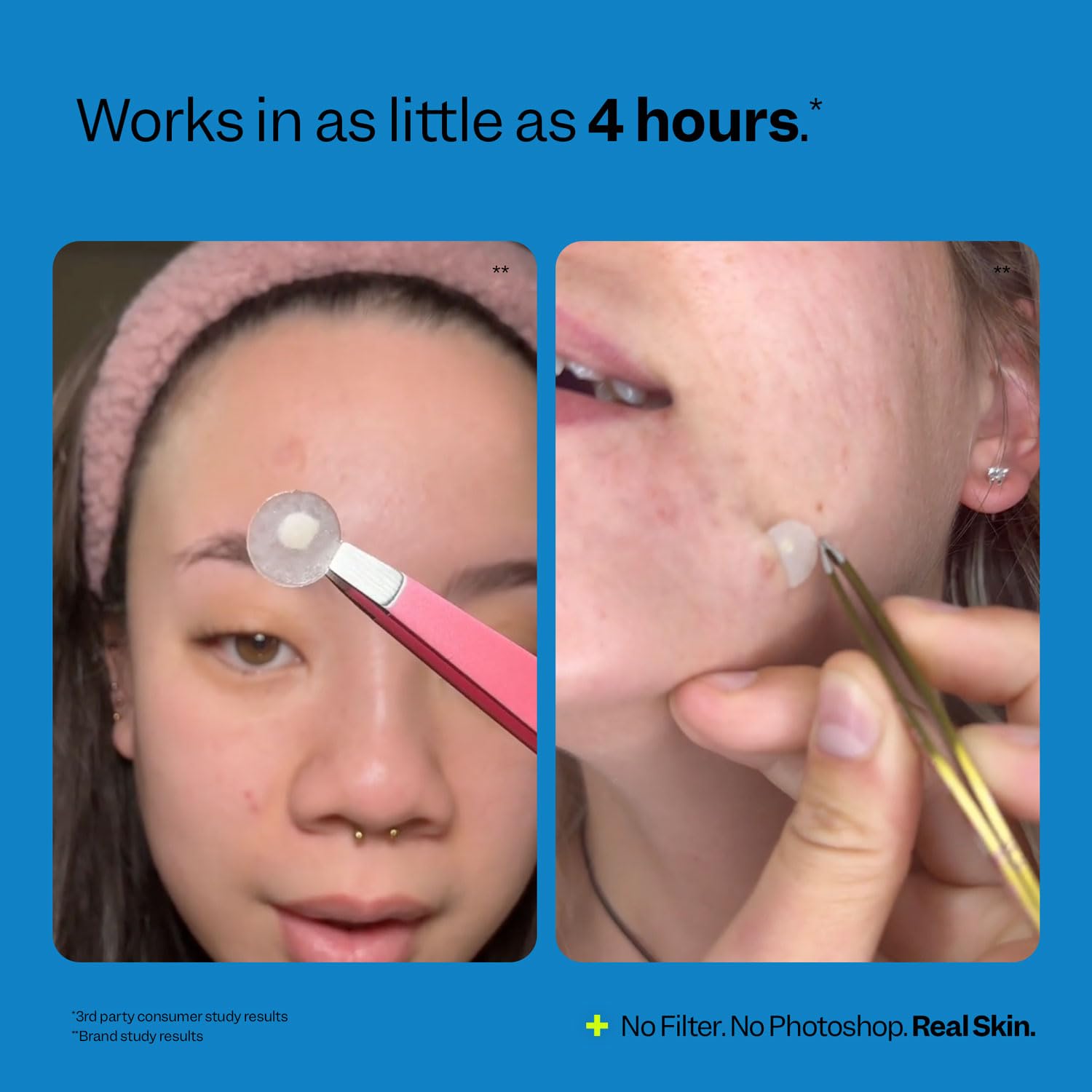 Demonstrates the quick effectiveness of the acne treatment product, showing it works in as little as 4 hours. Visually shows the before and after effect of using the product on acne spots,…
