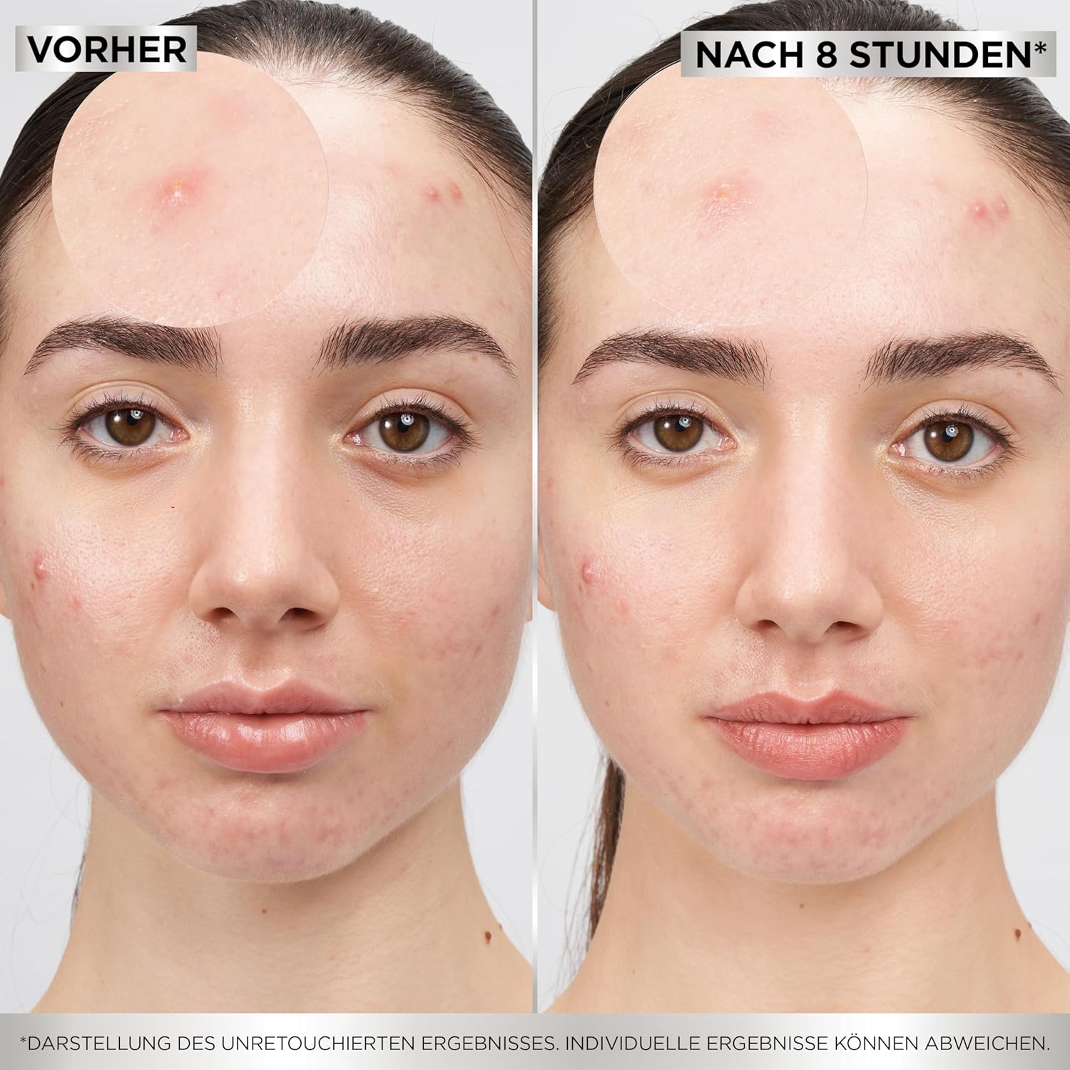 Demonstrates the effectiveness of an acne treatment product by showing visible improvement in skin condition after 8 hours of use.