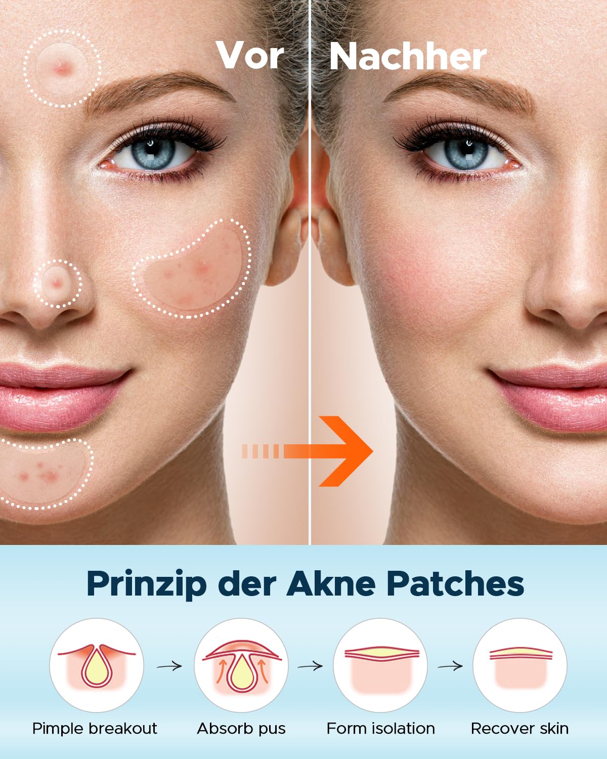 Demonstrates the effectiveness of acne patches in clearing skin blemishes, showing visible improvement in skin condition.