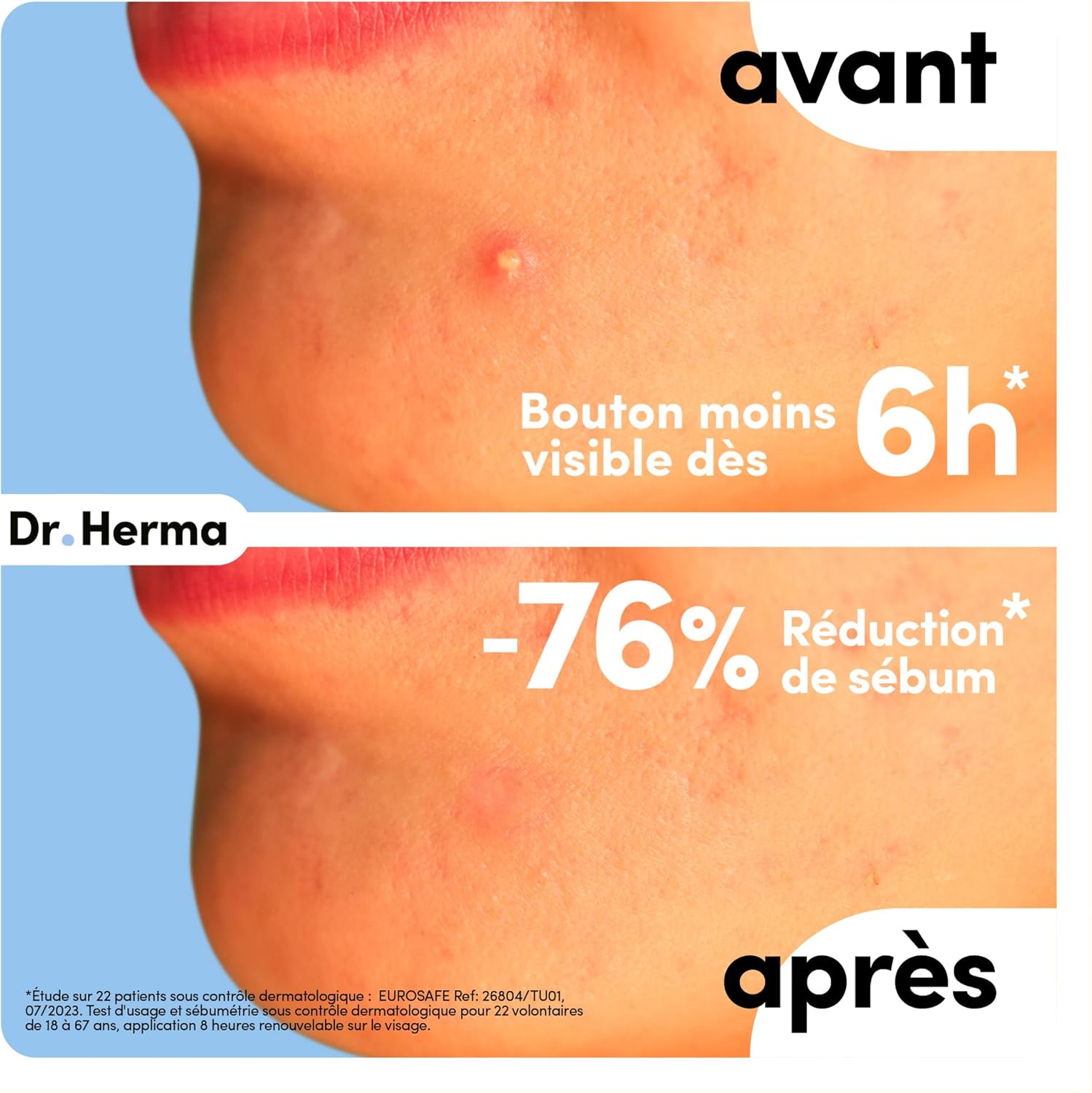 Demonstrates the product's effectiveness in reducing acne and controlling sebum production within 6 hours of use. Highlights the quantifiable benefit of 76% sebum reduction to show the product's…