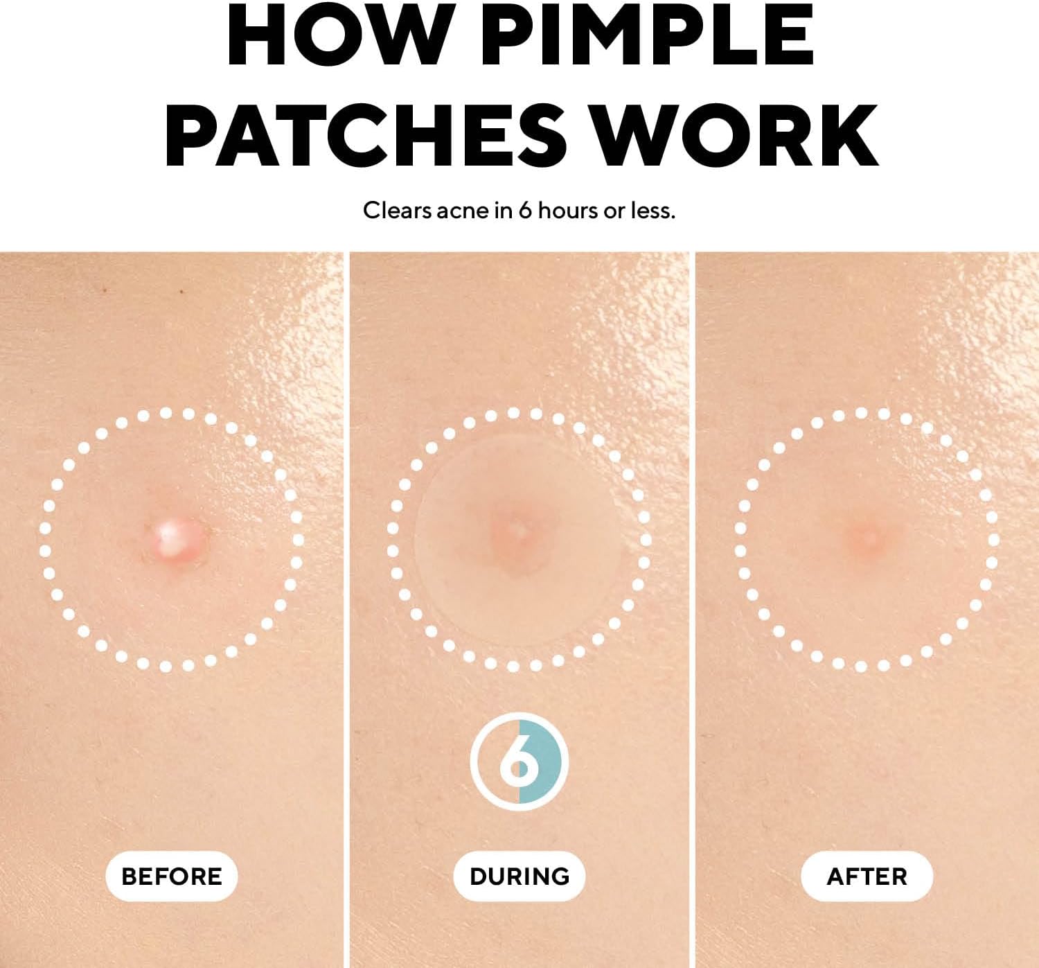 Demonstrates the effectiveness of pimple patches in clearing acne within 6 hours, showing a visible transformation from before to after use. Explains how pimple patches work to clear acne, providing…