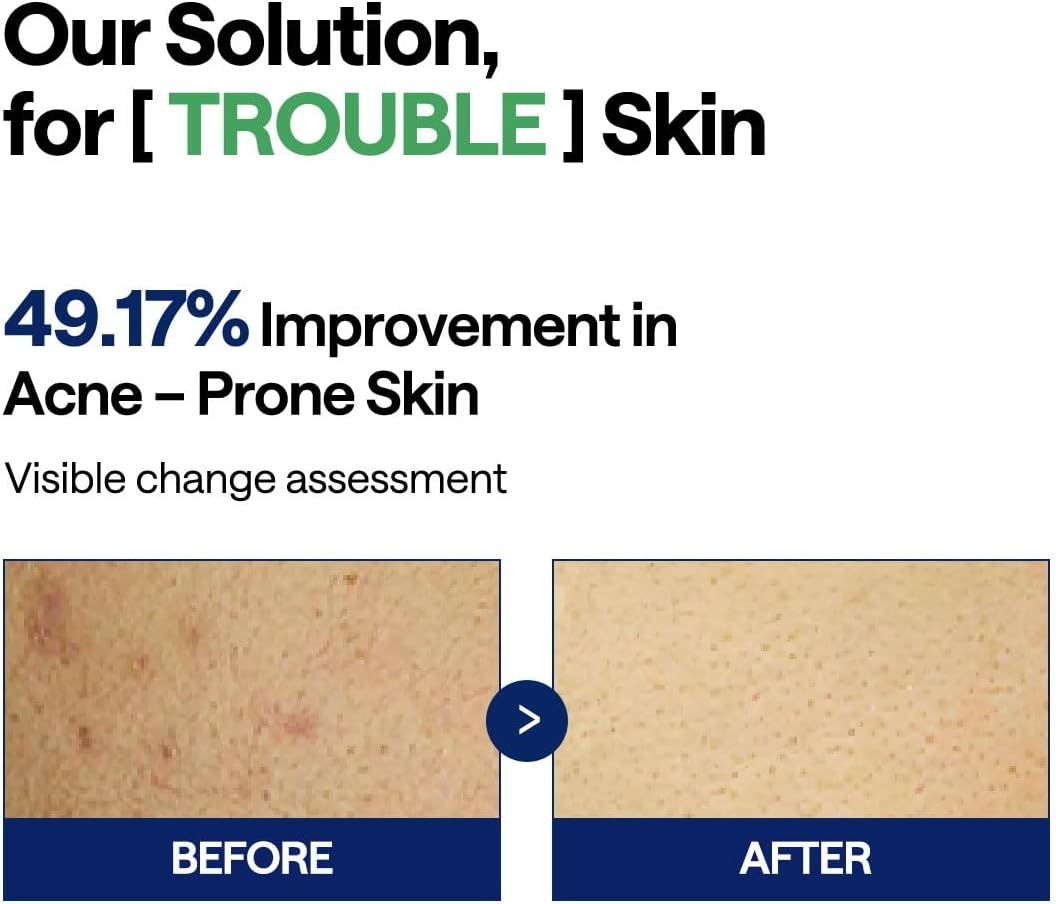 Demonstrates the product's effectiveness in treating acne-prone skin by showing a 49.17% improvement through a visible before-and-after comparison. Highlights a specific quantifiable performance…