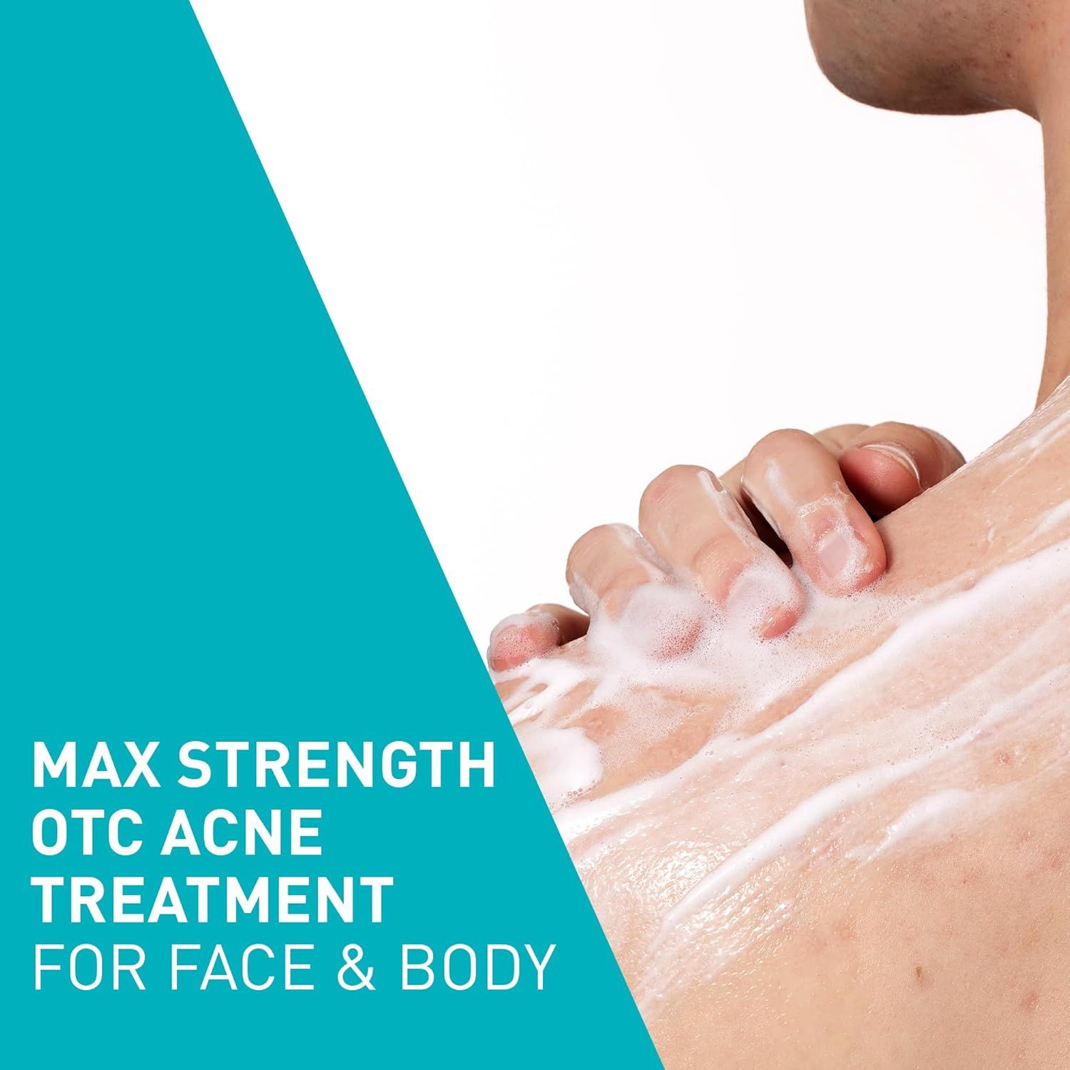Demonstrates that the acne treatment product can be used on multiple areas (both face and body), highlighting its versatility and broad application.…