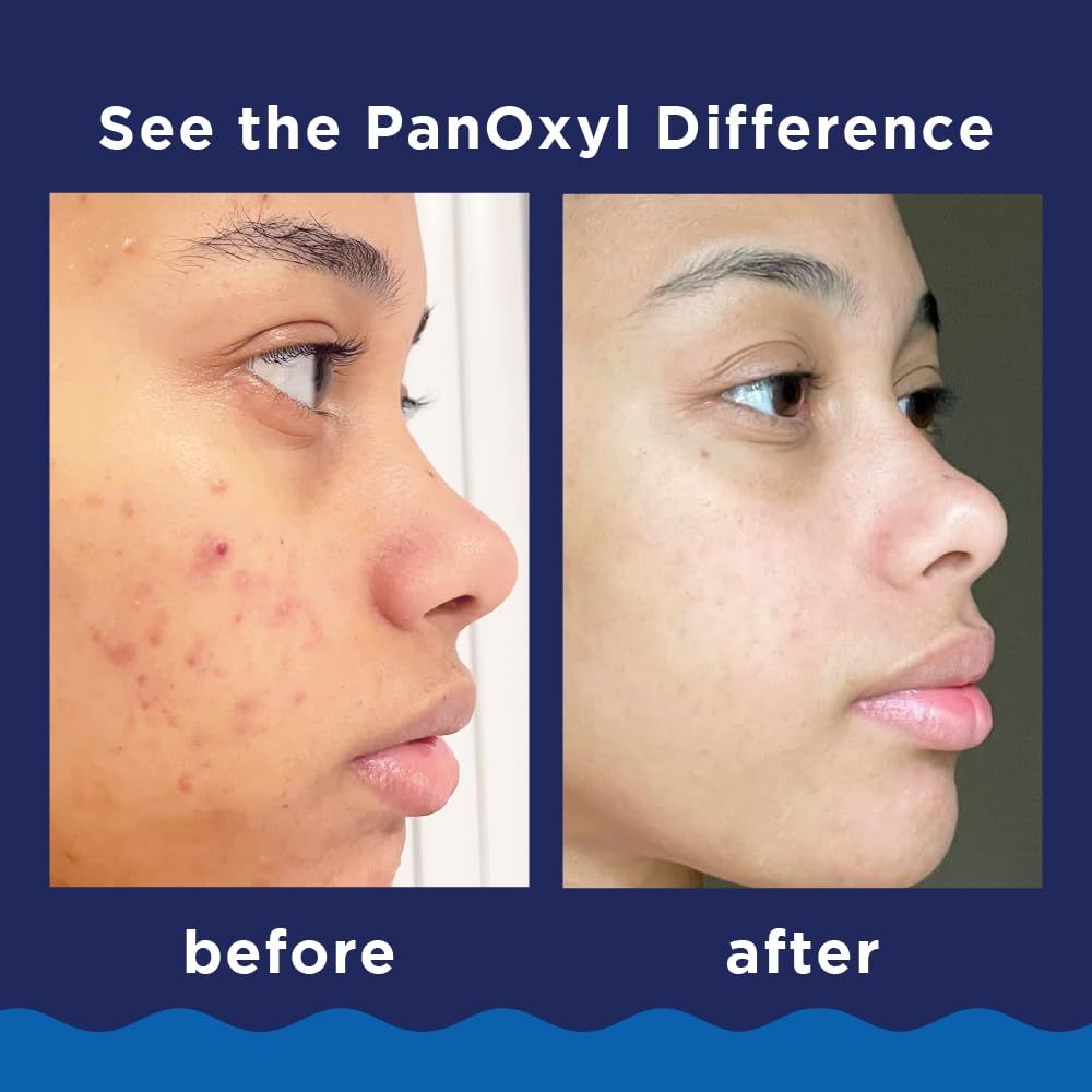 Demonstrates the visible transformation and effectiveness of PanOxyl in clearing acne and improving skin appearance, providing visual proof of results to build shopper confidence.