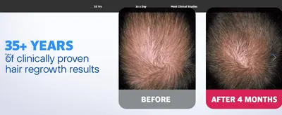 Shows a real before-and-after transformation after 4 months of use to visually prove the product's hair regrowth results.