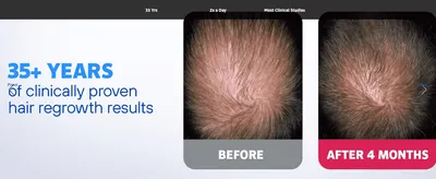 Visually proves the product's effectiveness by showing a customer's scalp before and after 4 months of use.