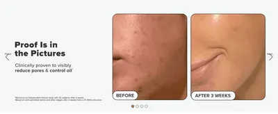 Provides visual proof of reduced pores and controlled oil after 3 weeks of use to build confidence in efficacy.