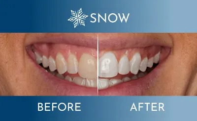 Comparison Chart Images for Snow 15