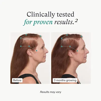Secondary Images for Amazon.com: Nutrafol Women's Balance Hair Growth Supplements