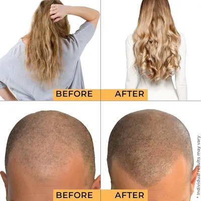 Visually demonstrates the transformative effects of a hair care or hair regrowth product by showing before and after results.