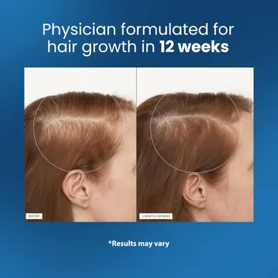 Visually demonstrates the product's effectiveness in promoting hair growth over a 12-week period.