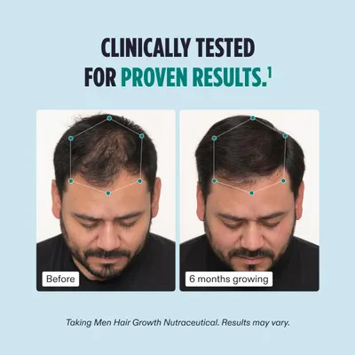 Visually demonstrates the product's effectiveness in promoting hair growth over a 6-month period.