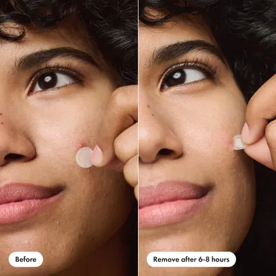 Demonstrates the effectiveness of the acne treatment product by showing a visible reduction in acne after 6-8 hours of use.