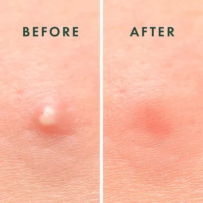 Demonstrates the effectiveness of the product in removing skin blemishes or imperfections.