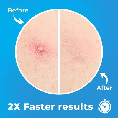 Secondary Images for Pimple Patches for Face (120 Patches)