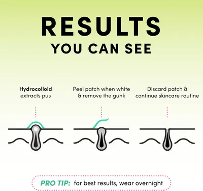 Explains the step-by-step process of using hydrocolloid acne patches, showing how they work to extract pus and when to remove them.