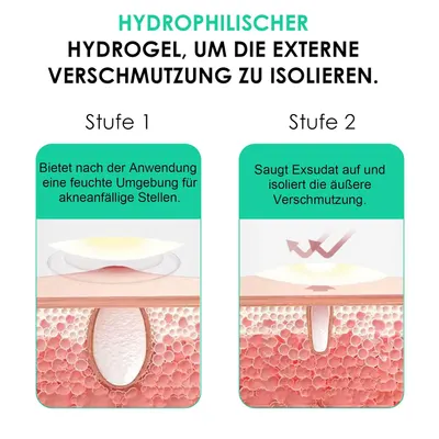 Explains how the product's hydrophilic hydrogel works to isolate external contamination in acne-prone areas.