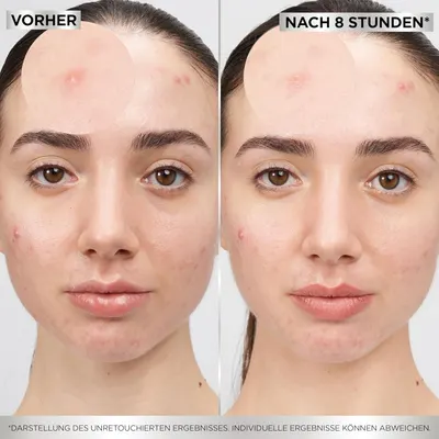 Demonstrates the effectiveness of an acne treatment product by showing visible improvement in skin condition after 8 hours of use.