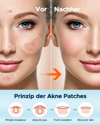 Demonstrates the effectiveness of acne patches in clearing skin blemishes, showing visible improvement in skin condition.