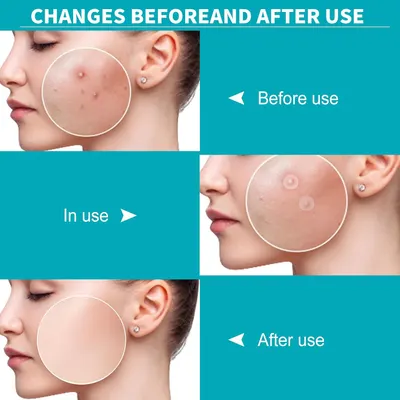 Demonstrates the effectiveness of the product in clearing acne and improving skin appearance.