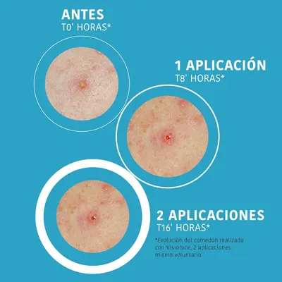 Demonstrates the effectiveness of the product in treating acne over time, showing visible improvement after 1 and 2 applications.