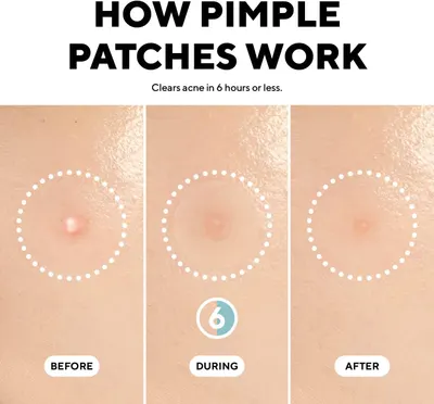 Demonstrates the effectiveness of pimple patches in clearing acne within 6 hours, showing a visible transformation from before to after use. Explains how…
