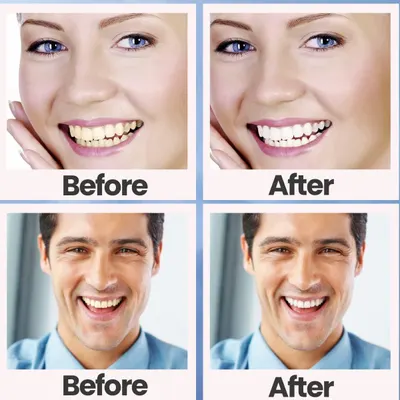 Demonstrates the visible transformation and whitening results achieved by using the product, showing yellowed teeth becoming bright white to prove effectiveness and build shopper confidence.