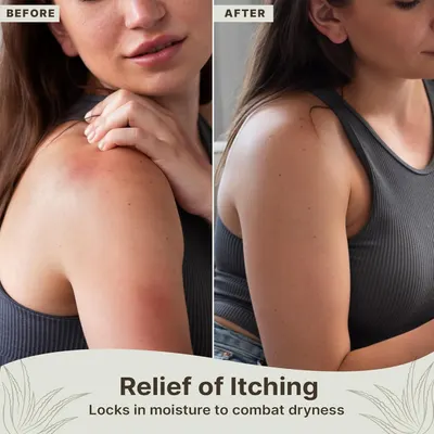 Demonstrates the product's effectiveness in relieving itching and dryness by showing a visual transformation of the skin from dry/irritated to smooth and moisturized.