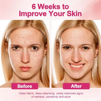 Demonstrates the visible transformation and effectiveness of the skincare product over 6 weeks, showing dramatic reduction in acne, redness, and sensitivity to reassure shoppers of proven results.