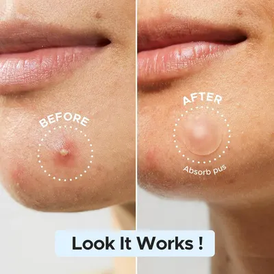Demonstrates the product's effectiveness in healing and clearing blemishes by showing visible transformation from an active blemish to clear, smooth skin.