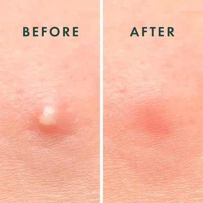 Demonstrates the product's effectiveness in removing skin blemishes and improving skin texture, providing visual proof of results to build shopper confidence.