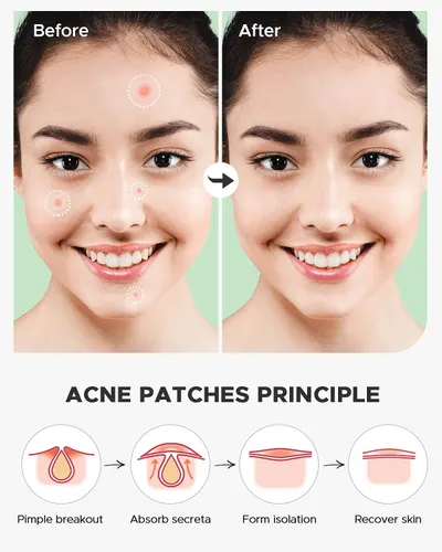 Demonstrates the effectiveness of the acne patches by showing visible reduction of blemishes from before to after use, reassuring shoppers of the product's ability to clear skin. Explains the…
