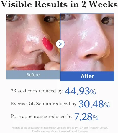 Demonstrates visible skin transformation results after 2 weeks of product use, showing significant reduction in blackheads, excess oil, and pore appearance to prove product effectiveness. Provides…