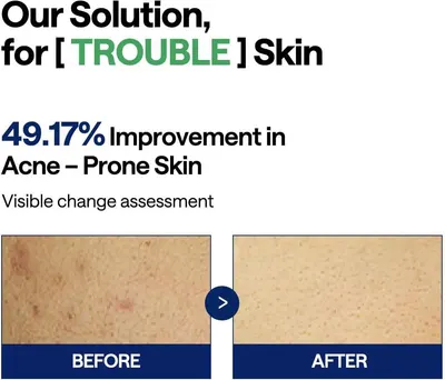 Demonstrates the product's effectiveness in treating acne-prone skin by showing a 49.17% improvement through a visible before-and-after comparison. Highlights a specific quantifiable performance…