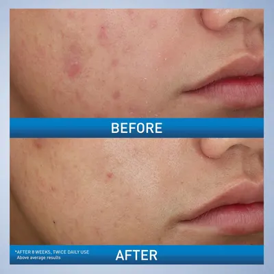 Demonstrates the visible transformation and effectiveness of the skincare product by showing reduced redness and improved skin clarity after 8 weeks of use.