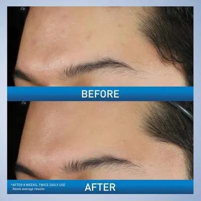 Demonstrates the visible transformation in skin condition after 8 weeks of twice-daily product use, showing reduced acne and improved skin clarity to prove product effectiveness.