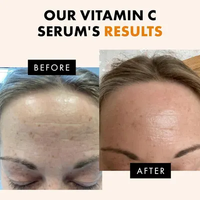 Demonstrates the visible transformation and effectiveness of the Vitamin C serum by showing improved skin clarity and reduced dark spots, reassuring shoppers of real results.